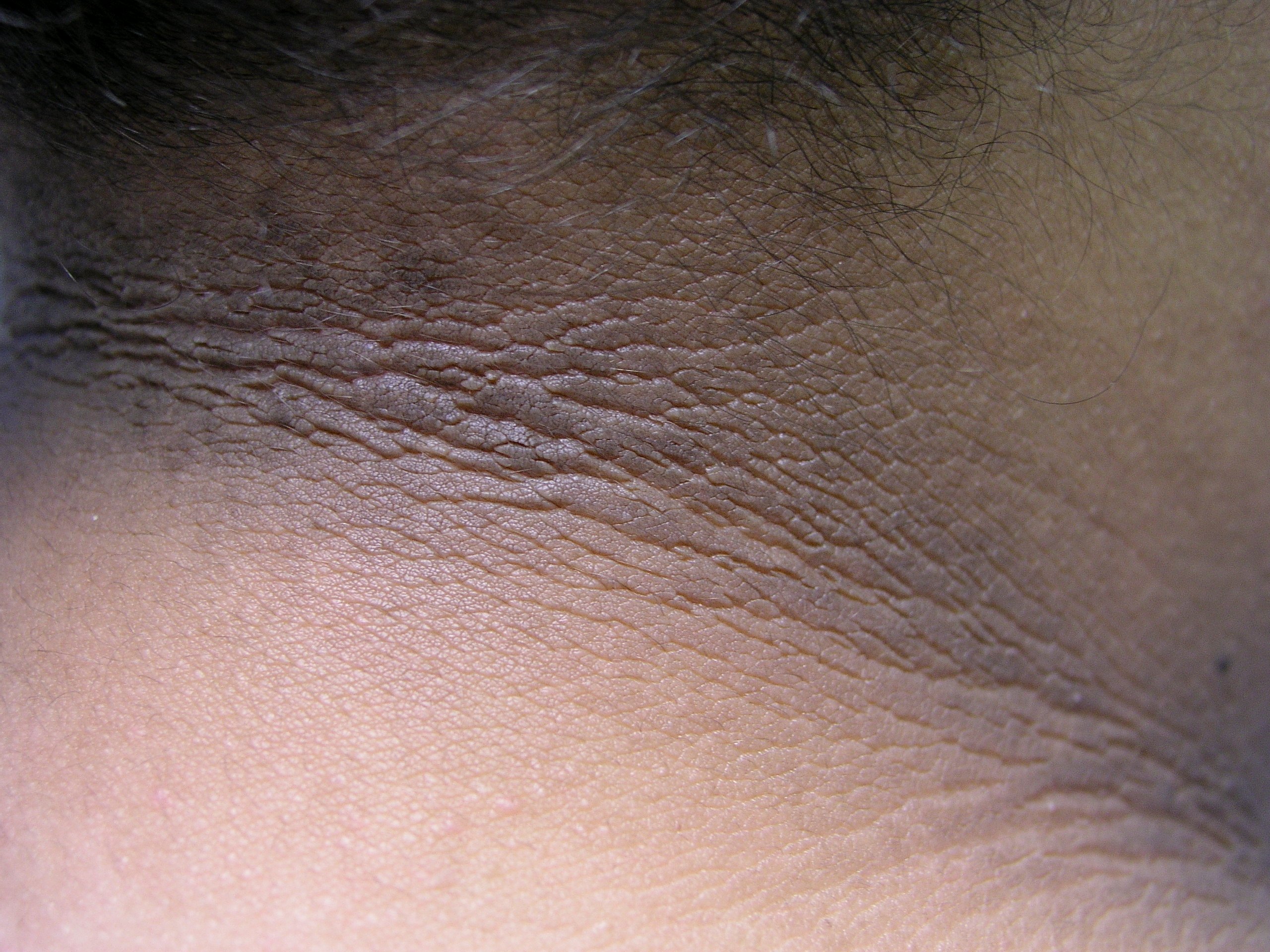 acanthosis-nigricans-dystrophie-papillaire-et-pigmentaire